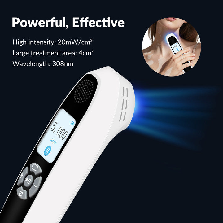 Handheld 308nm Excimer UVB Lamp – High Intensity, High Targeting Light Therapy for Vitiligo